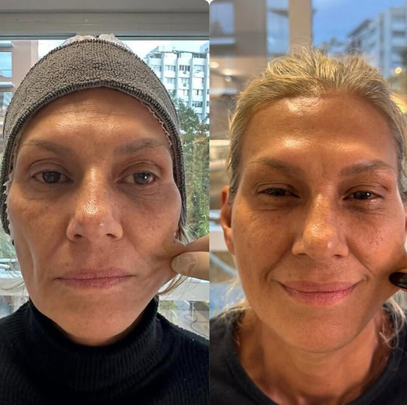 Bioestimuladores de Colágeno